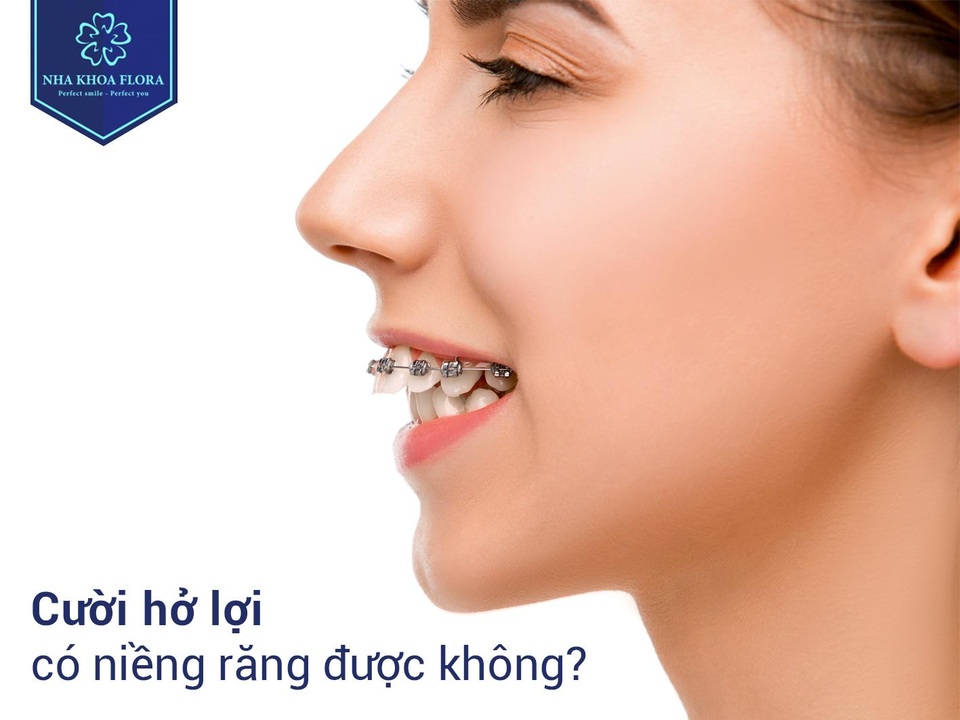3 cách cười không hở lợi mới nhất bạn nên biết - 1 3 cách cười không hở lợi mới nhất bạn nên biết - 1