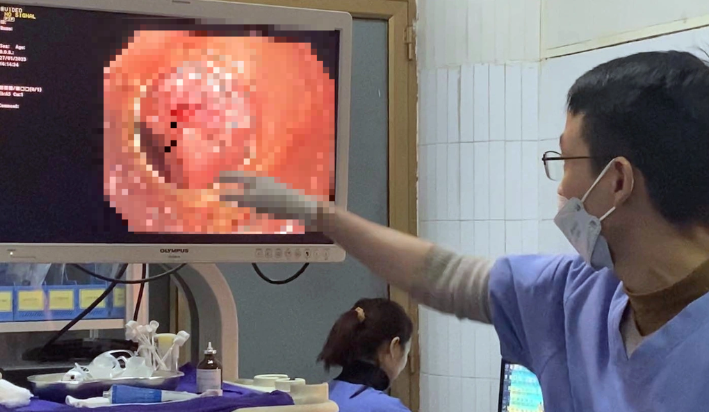 Người phụ nữ thủng ruột vì thói quen sau khi ăn của nhiều người Việt - 2 Người phụ nữ thủng ruột vì thói quen sau khi ăn của nhiều người Việt - 2