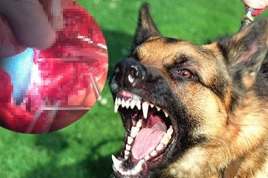 Bé trai 2 tuổi bị chó béc giê cắn rạn sọ, lòi nhãn cầu