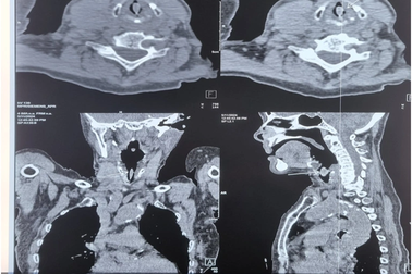 Nữ bệnh nhân gặp nạn nguy kịch sau khi ăn hồng xiêm