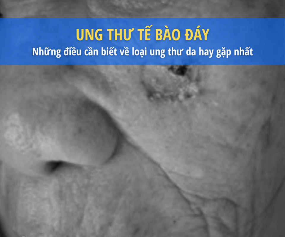 Cách bảo vệ da khỏi loại ung thư hay gặp nhất - 1 Cách bảo vệ da khỏi loại ung thư hay gặp nhất - 1