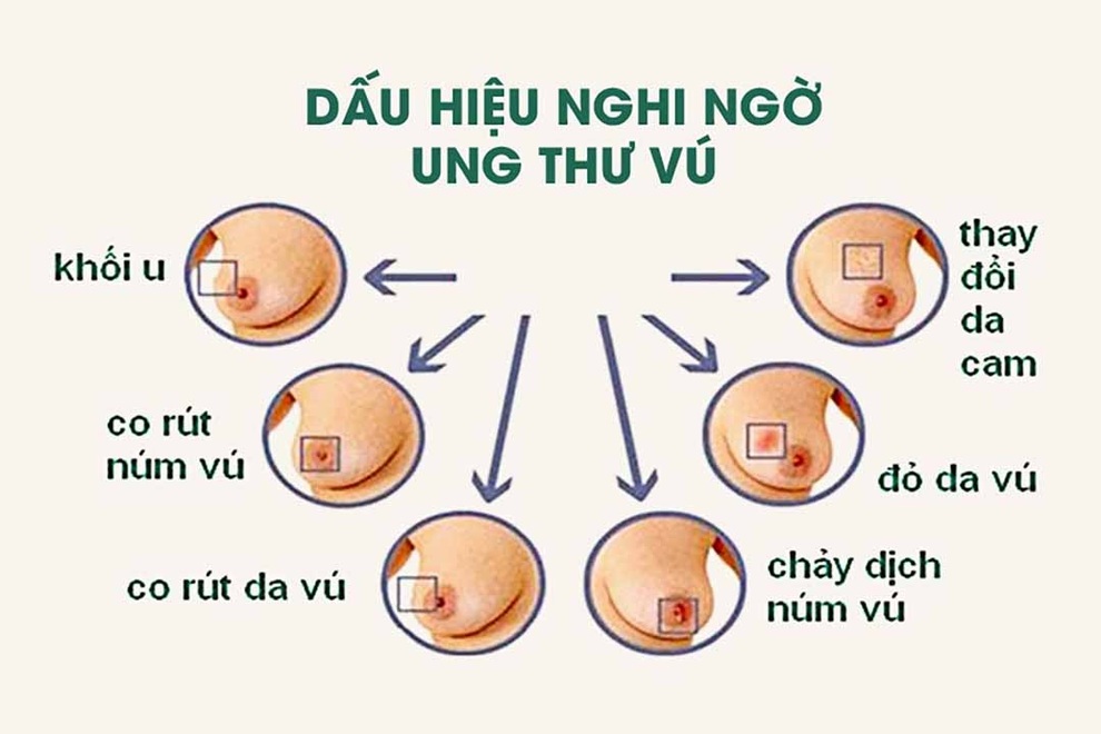 Dấu hiệu sớm cảnh báo ung thư vú - 1 Dấu hiệu sớm cảnh báo ung thư vú - 1