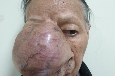 Khối u khổng lồ "ăn sâu" vào xương vùng mặt người phụ nữ nghèo