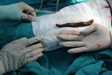 Con vắt “khủng” sống nhiều ngày trong cổ họng bé trai 6 tuổi