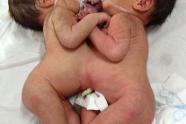 Hai bé gái sinh non dính liền nhau vùng ngực bụng