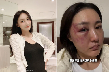 Hot girl nổi tiếng mạng xã hội cầu cứu dân mạng vì bị chồng bạo hành