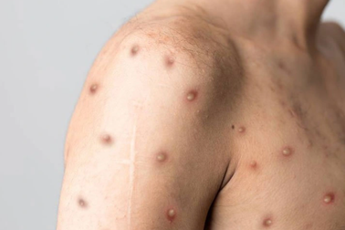 Đi du lịch Nam Phi về, người đàn ông nghi mắc bệnh đậu mùa khỉ