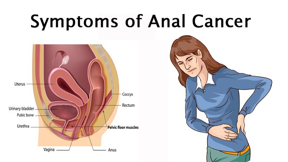 Những dấu hiệu cảnh báo ung thư hậu môn - 2 Những dấu hiệu cảnh báo ung thư hậu môn - 2