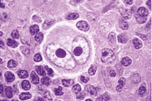 Bệnh nhân u lympho Hodgkin cần biết điều này sau điều trị?