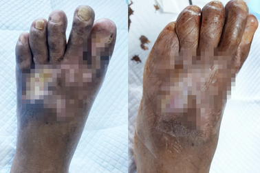 Người đàn ông lở loét nặng, suýt bị cắt cụt chi sau một tháng mắc Covid-19