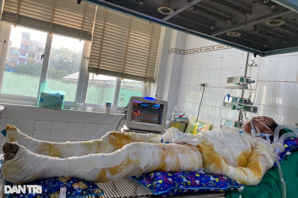 Xót xa hoàn cảnh người bố 4 con bị bỏng 85% cơ thể - 2 Xót xa hoàn cảnh người bố 4 con bị bỏng 85% cơ thể - 2
