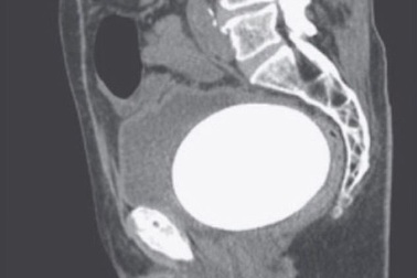 Hy hữu viên sỏi to như quả trứng đà điểu trong bàng quang