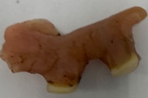 Nuốt luôn răng giả khi uống thuốc, người đàn ông nhập viện cấp cứu