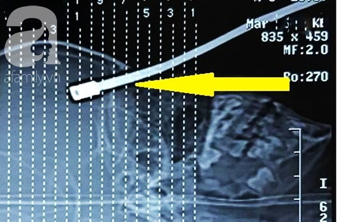 Mẹ hốt hoảng khi thấy con trai 5 tuổi cầm thanh sắt chạy đi chơi thì bị đâm xuyên hốc mắt lên đến não - Ảnh 2. Mẹ hốt hoảng khi thấy con trai 5 tuổi cầm thanh sắt chạy đi chơi thì bị đâm xuyên hốc mắt lên đến não - Ảnh 2.