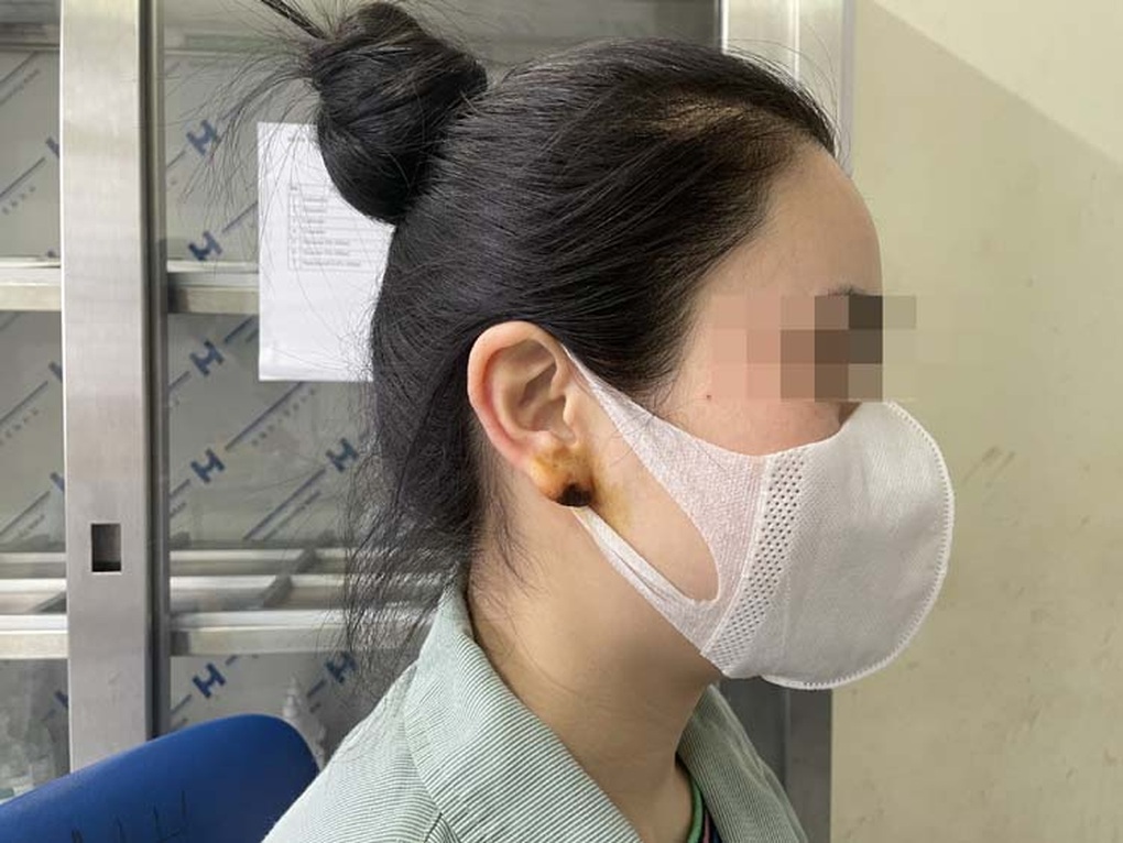 Lào Cai: Hậu quả tai hại vì cấy chỉ nâng mũi và tiêm filler tai Phật - 1 Lào Cai: Hậu quả tai hại vì cấy chỉ nâng mũi và tiêm filler tai Phật - 1