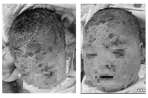 Tắm lá, bé trai 8 tháng tuổi nứt da đầu, bong tróc khắp mặt