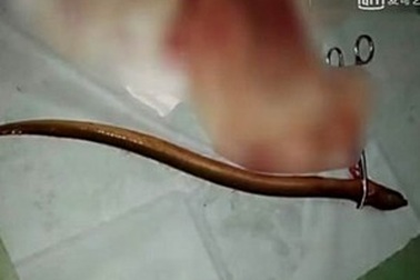 Suýt chết vì nhét lươn vào... hậu môn để chữa táo bón