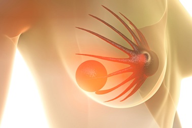 Giá thuốc trị ung thư vú Ibrance là quá đắt đối với hệ thống y tế công