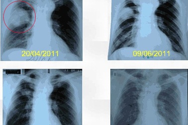 Đốt u phổi bằng sóng cao tần, hi vọng mới của bệnh nhân ung thư 