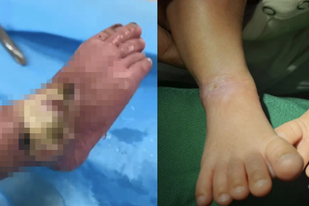 Bé gái bị đèn trị vàng da làm bỏng nặng hồi phục ngoạn mục nhờ tế bào gốc - 3 Bé gái bị đèn trị vàng da làm bỏng nặng hồi phục ngoạn mục nhờ tế bào gốc - 3