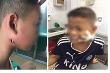 Hà Nội: Trong nửa tháng, 2 anh em ruột tử vong do nhiễm khuẩn Whitmore