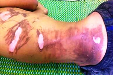 Bỏng toàn thân vì ngậm xăng phun lửa lúc múa lân