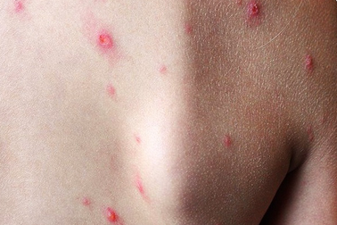 Người đầu tiên ở Đồng Nai bị đậu mùa khỉ