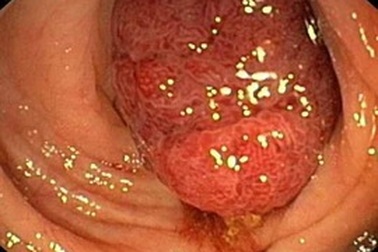 Ung thư đại tràng: Dễ mắc khó phát hiện