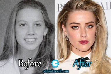 Vợ cũ Johnny Depp bị nghi làm đẹp bằng “dao kéo”