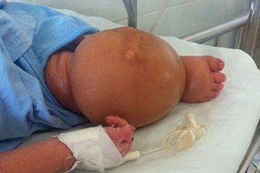Bé sơ sinh chân phù to bất thường như quả bóng