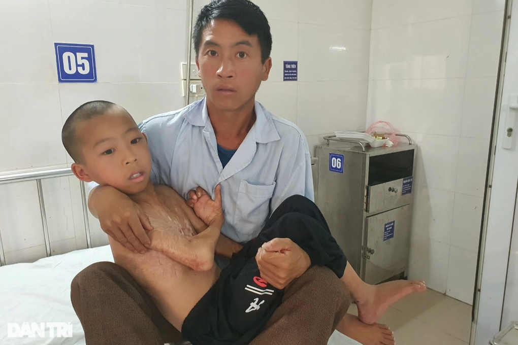 Nghẹn đắng trước cơ thể biến dạng khủng khiếp do bỏng của bé trai 14 tuổi - 6 Nghẹn đắng trước cơ thể biến dạng khủng khiếp do bỏng của bé trai 14 tuổi - 6