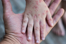 Bé trai ở Đắk Lắk tử vong do bệnh tay chân miệng