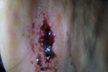 Bé 4 tuổi bị cô giáo mầm non “quệt tay” chảy máu tai