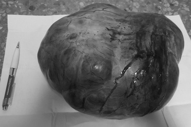 Phẫu thuật khối u “khủng” nặng 4kg trong bụng cụ bà