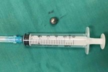 Bé trai 5 tuổi bị đạn từ súng đồ chơi bắn xuyên thủng mặt