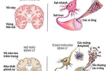 Gốc tự do “tàn phá” bộ não