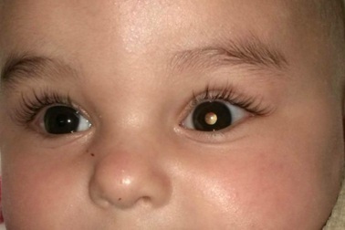 Dấu hiệu "mắt mèo" cảnh báo ung thư ở trẻ