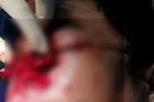 Nổ bình ga mini khi nấu cơm, bệnh nhân vỡ nhãn cầu mắt, dập nát mũi