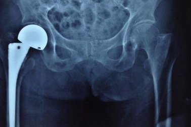 Bệnh viện quận thay khớp háng cho cụ bà gần 100 tuổi