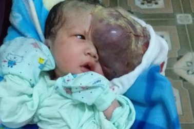 Mẹ chết ngất nhìn con chào đời mang "u khủng" dị thường trên mặt!