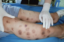 Tự tiêm canxi, nữ bệnh nhân xuất hiện chi chít nốt hoại tử ở tay chân