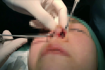 16 điều cần nhớ kỹ khi nâng mũi để không ôm hận vì "bác sĩ tiktok"