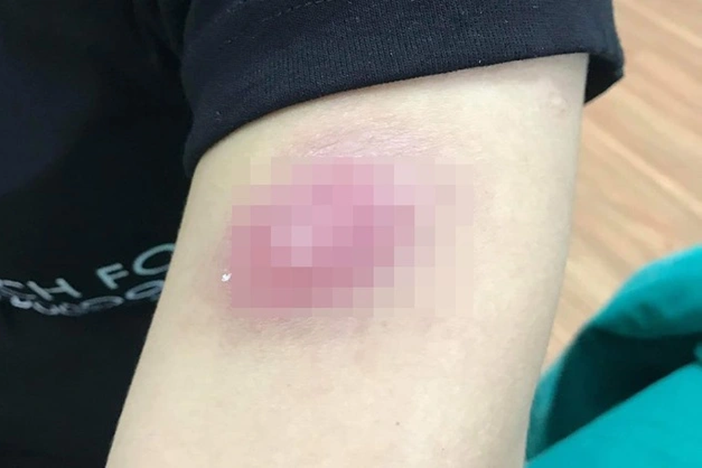 Hà Nội: Cô gái trẻ nổi u cục chi chít người sau liệu trình siêu hủy mỡ - 1 Hà Nội: Cô gái trẻ nổi u cục chi chít người sau liệu trình siêu hủy mỡ - 1