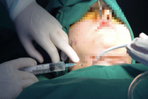 Cô gái nâng ngực trong khách sạn rồi tử vong: Làm gì để xóa "thẩm mỹ chui"?