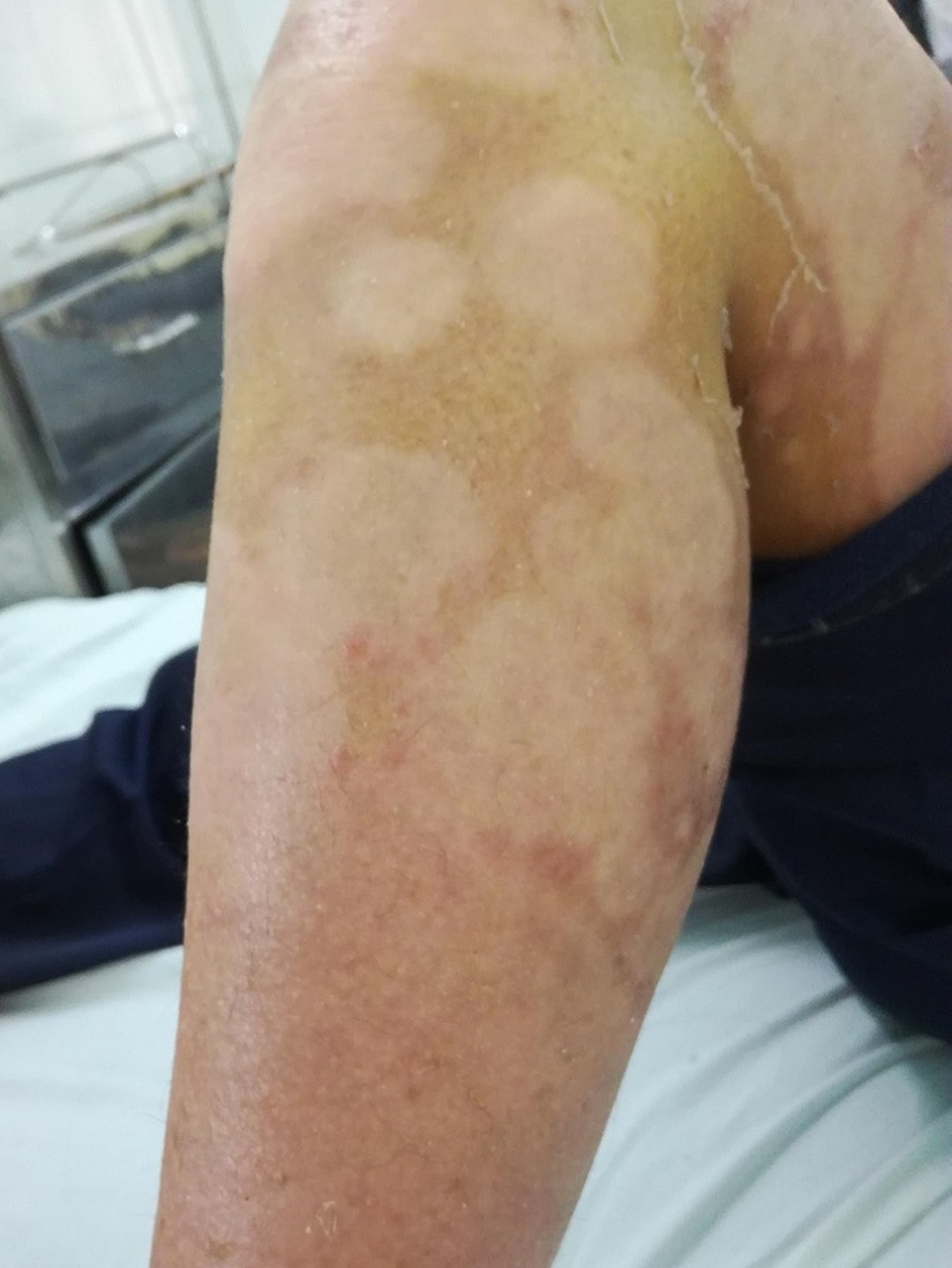 Tự điều trị vảy nến, nữ bệnh nhân lở loét toàn thân - 2 Tự điều trị vảy nến, nữ bệnh nhân lở loét toàn thân - 2
