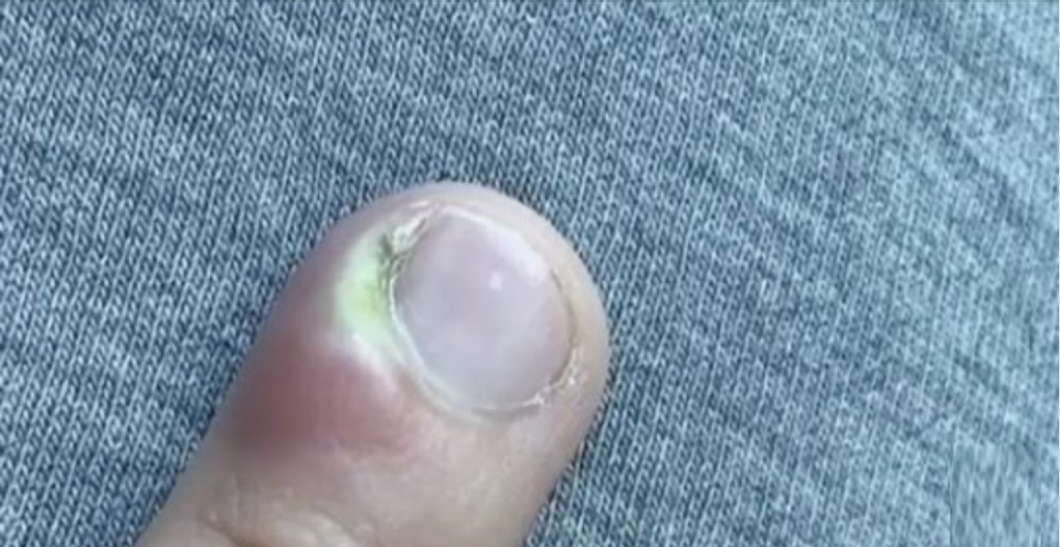 Cô gái 18 tuổi suýt phải cắt cụt ngón tay vì thói quen nhiều người mắc phải - 1 Cô gái 18 tuổi suýt phải cắt cụt ngón tay vì thói quen nhiều người mắc phải - 1