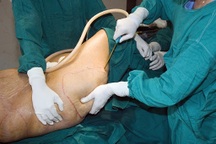 14 giờ sau hút mỡ bụng, người phụ nữ tử vong