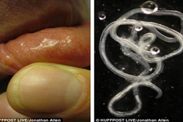 Ấu trùng giun di chuyển dưới da do nhiễm từ động vật