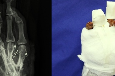 Người phụ nữ bị dập nát tay khi thu gom sắt vụn vì chạm phải vật lạ