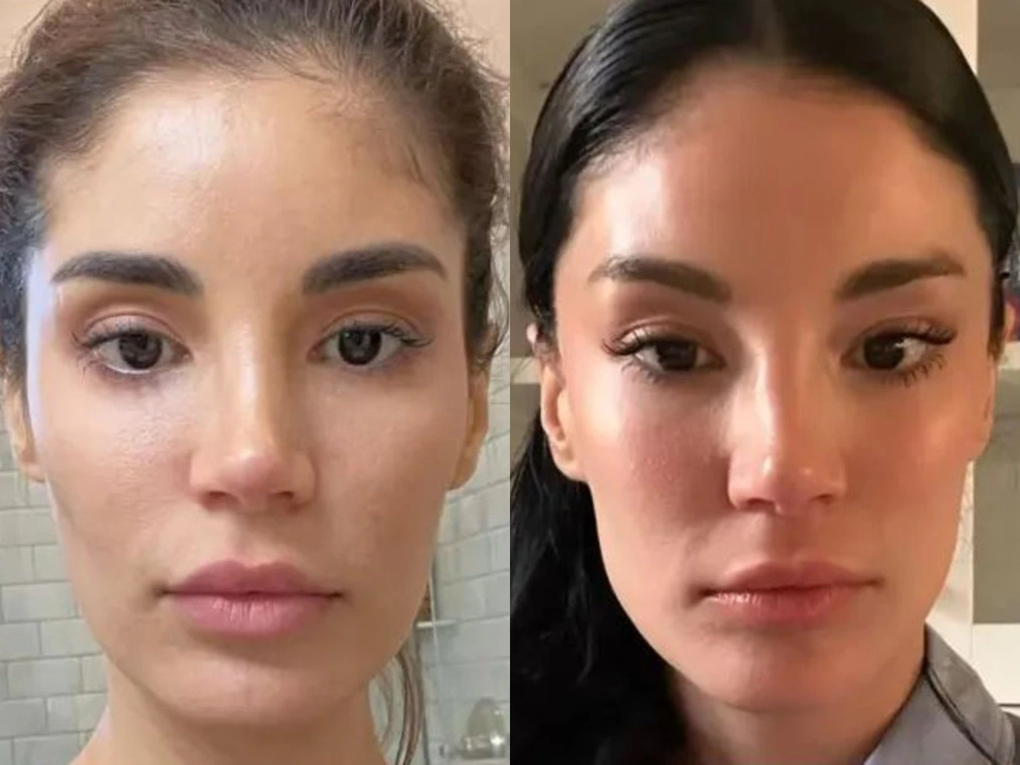 Trào lưu kéo căng da giống siêu mẫu lan rộng trong giới trẻ - 3